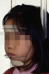 第8症例MPA（ななめ）.jpg