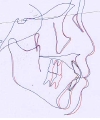 第8症例（重BCD：全体）.jpg